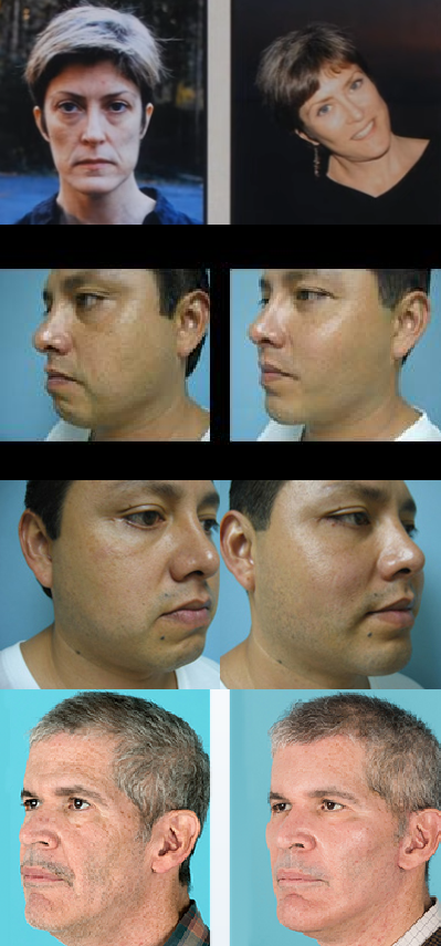 Malar implants