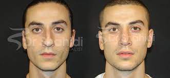 Malerhinoplastybeforeandafter