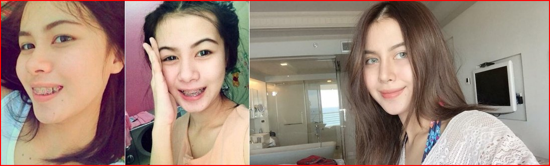 Asian ridge implant