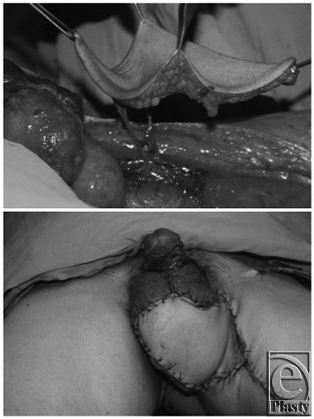 Medial circumflex femoral artery perforator flap top Early postoperative view