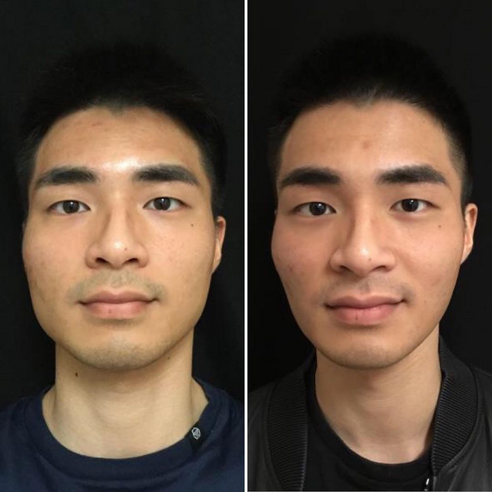 Screenshot 2022 11 09 at 19 58 46 botox masseter men   Ricerca Google