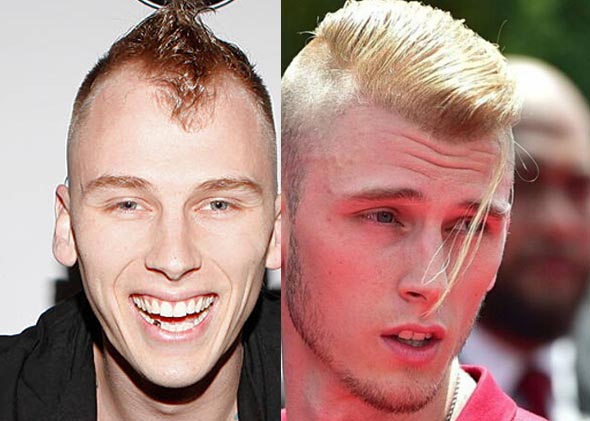 Machine gun kelly hair transplant before and after