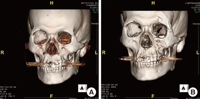 Preoperative and postoperative 3 D facial bone CT images Preoperative and postoperative