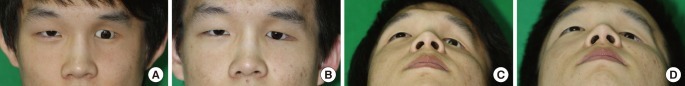 Case 1 preoperative and postoperative photographs Preoperative anteroposterior view A