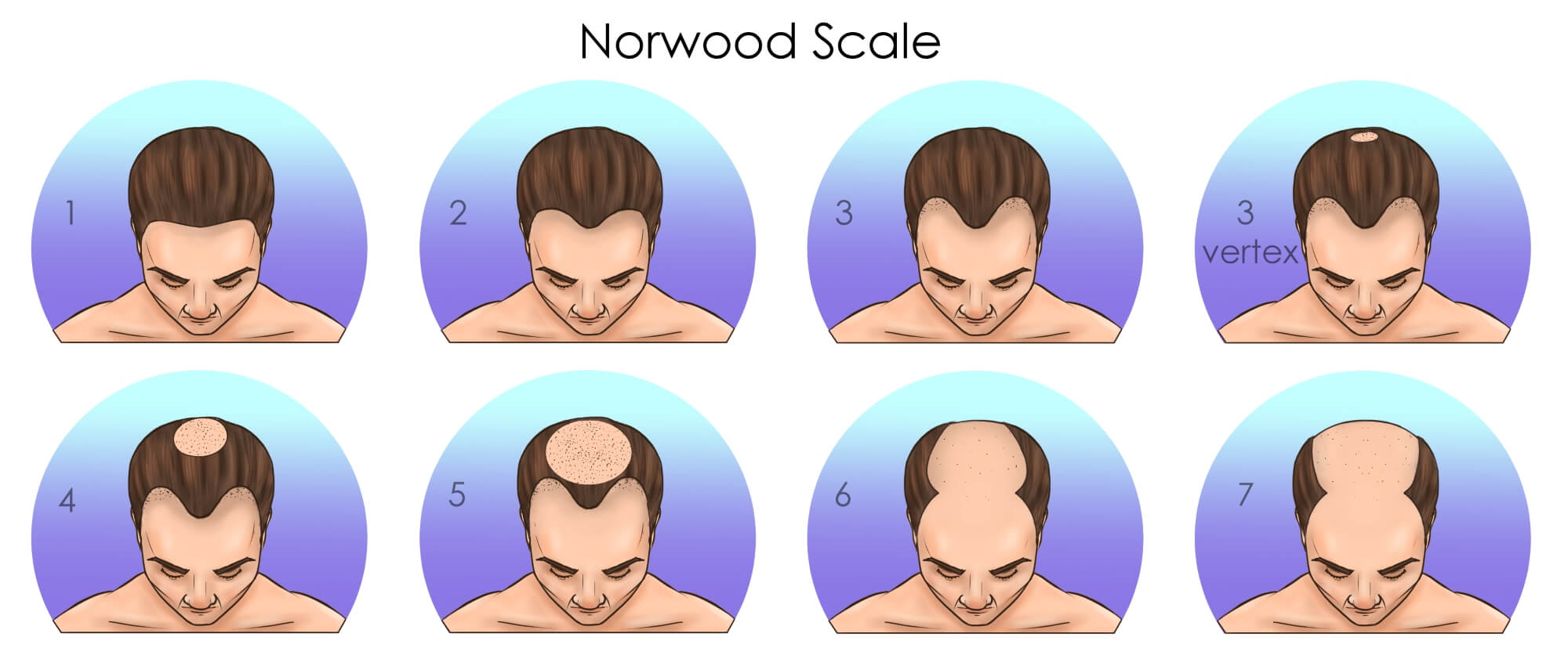 Norwood hair loss scale