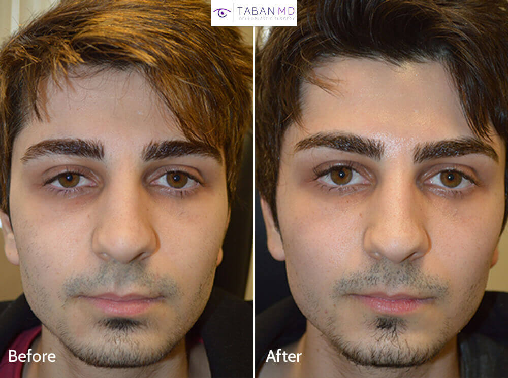 Taban beforeafter 9 1