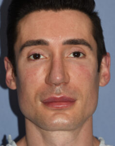 Male IOM implants front before Dr Barry Eppley Indianapolis 237x300
