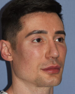 Male IOM implants oblique after Dr Barry Eppley Indianapolis 240x300