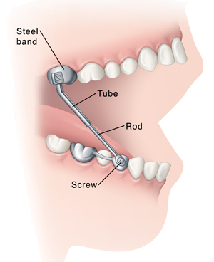 Side view of teeth in open mouth showing herbst appliance attached to lower and upper teeth 2