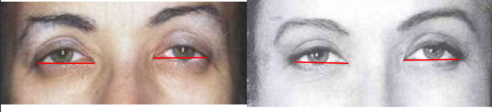 Canthoplasty2