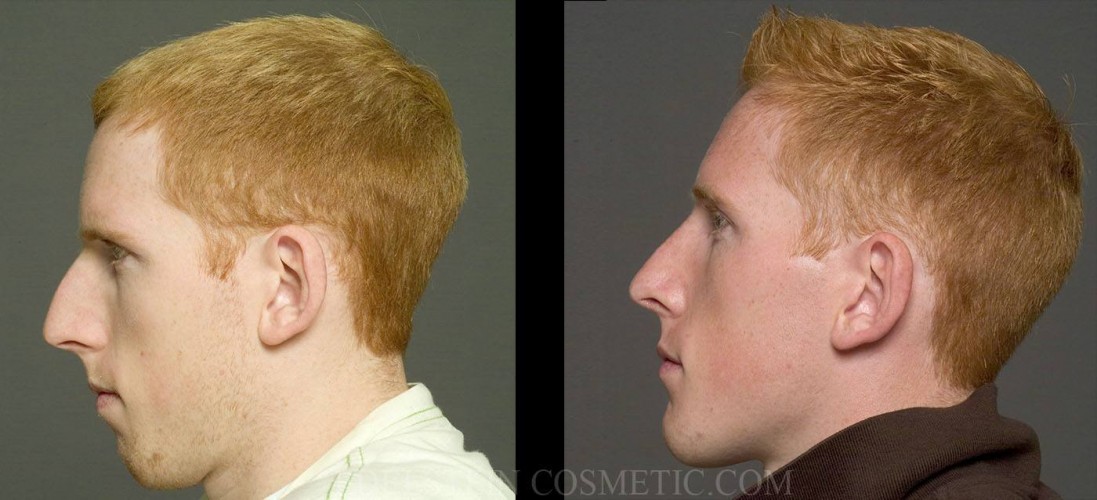 Chin Augmentation Toronto Before after p02 02 2 e1447191855475