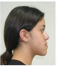 Screenshot 2022 12 07 at 13 24 03 underbite before and after   Ricerca Google