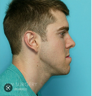 Screenshot 2022 12 07 at 13 23 46 underbite before and after   Ricerca Google