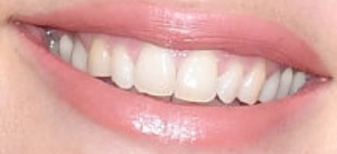 Doutzen kroes teeth lg2