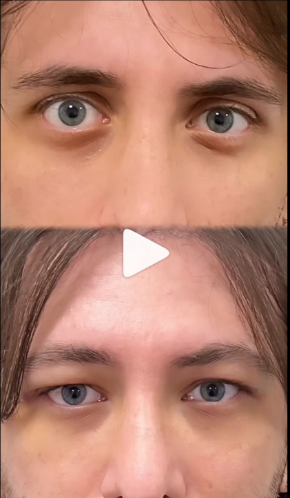 Screenshot 2022 12 22 at 13 09 07 hunter eyes surgery result