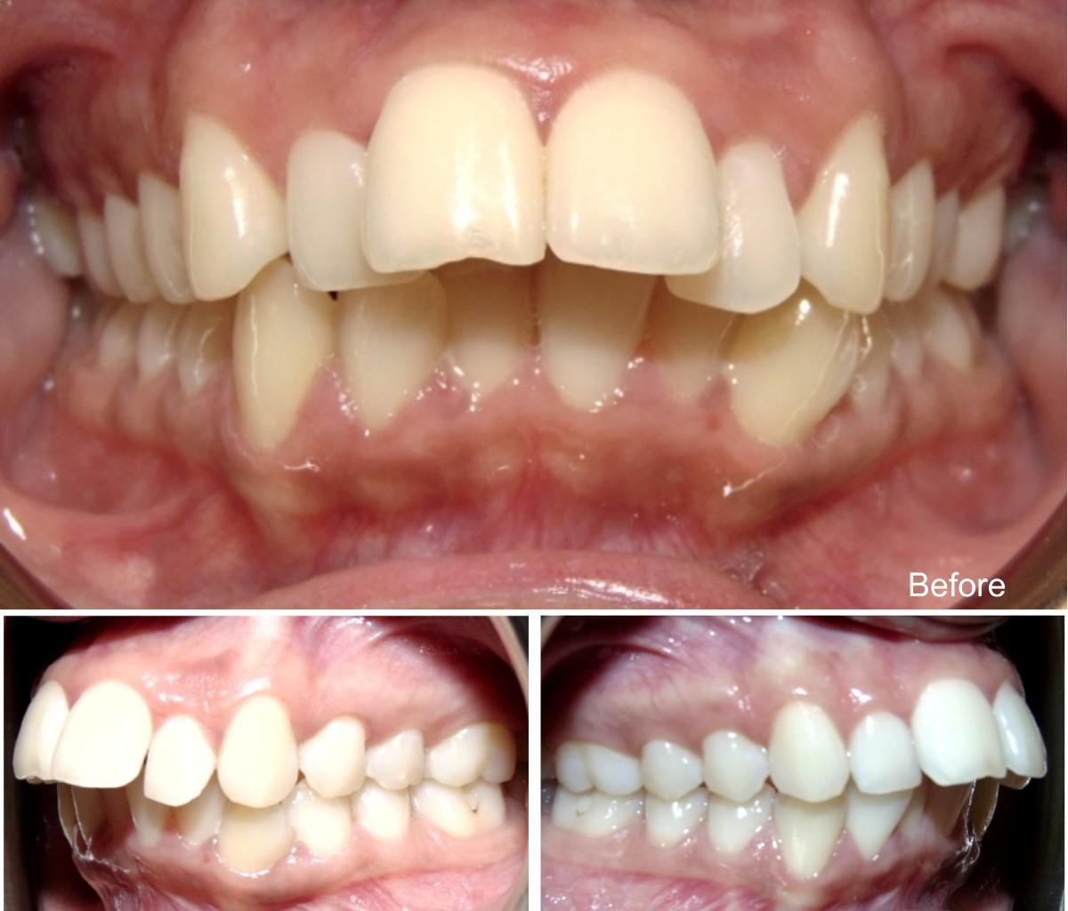 Jugdeep 23 years old overjet and overbite before invisalign treatment