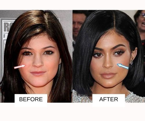 Kylie jenner nose job