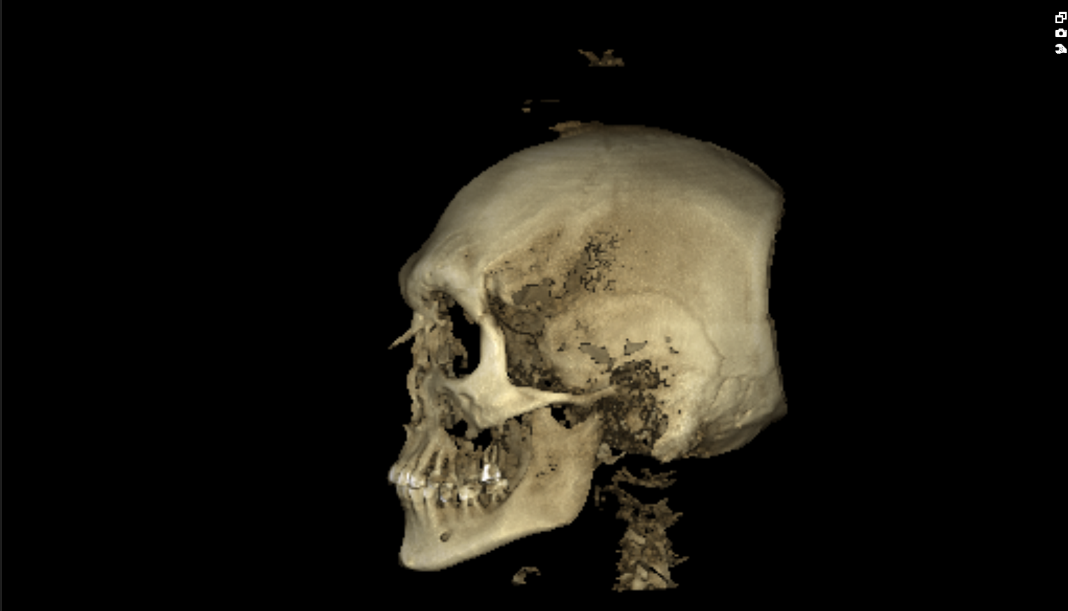 Ct scan side 1