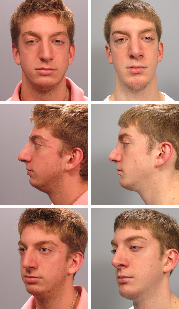 Chin augmentation 10