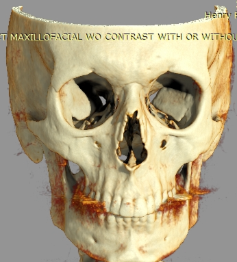 Front skull