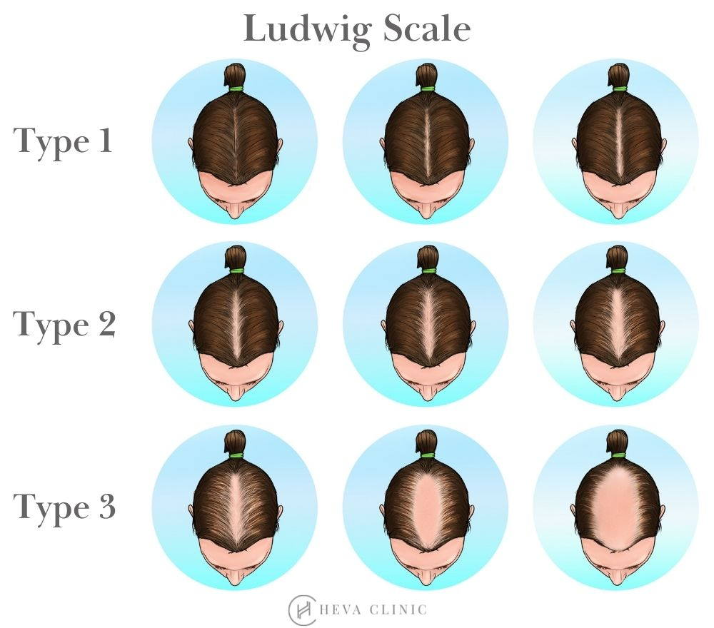 Bald scale1