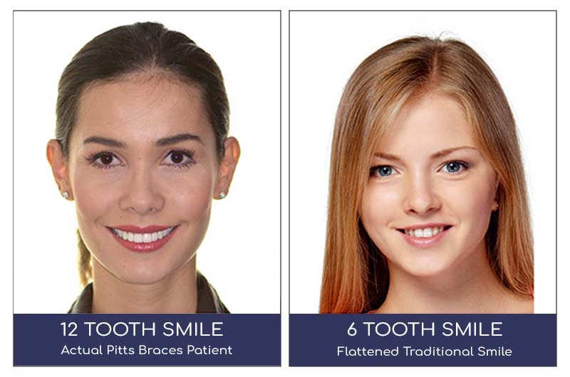6 vs 12 tooth smile adult braces