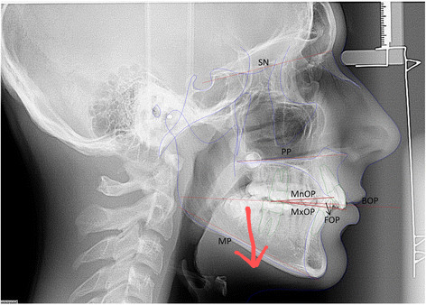 Occlusal planes and reference planes used for cephalometric measurements2