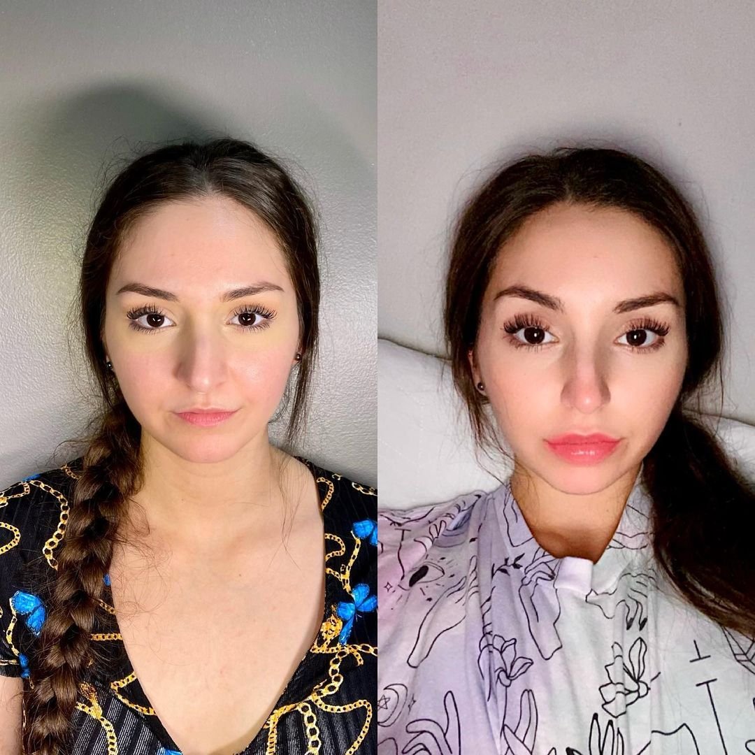 Lushrx lip fillers before after