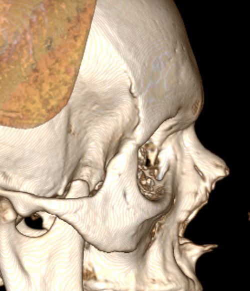 maxilla.png