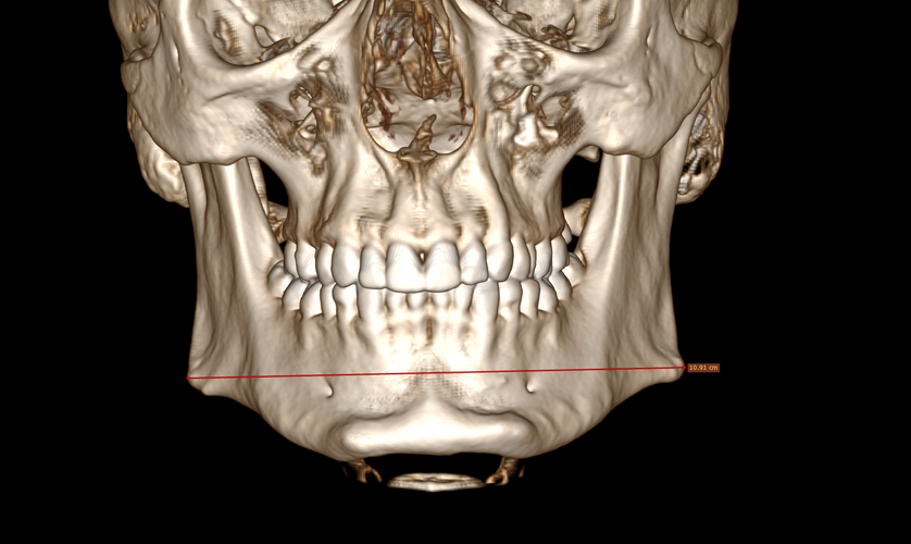bigonialwidth.png