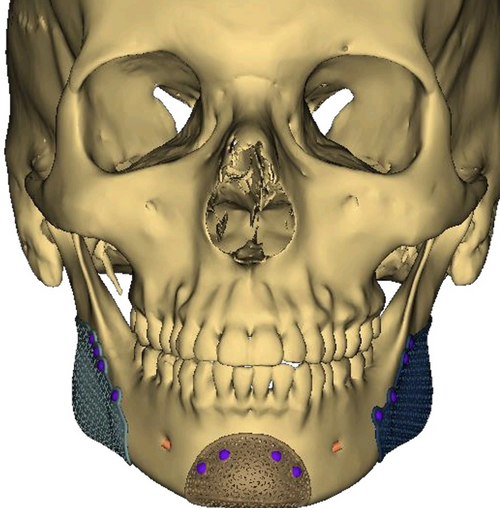 Surgeron Scan.png