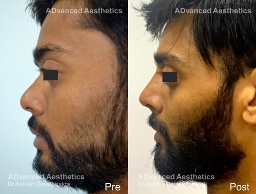 Rhinoplasty-Case-15-side.jpg