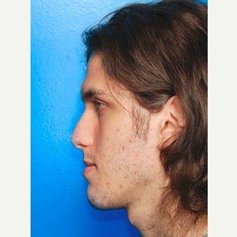 Orthognathic-Surgery-before-2346877-2505499.jpg