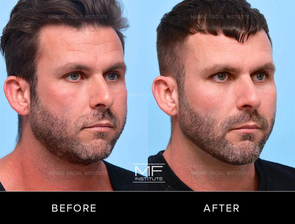 DCM Before After 640 1