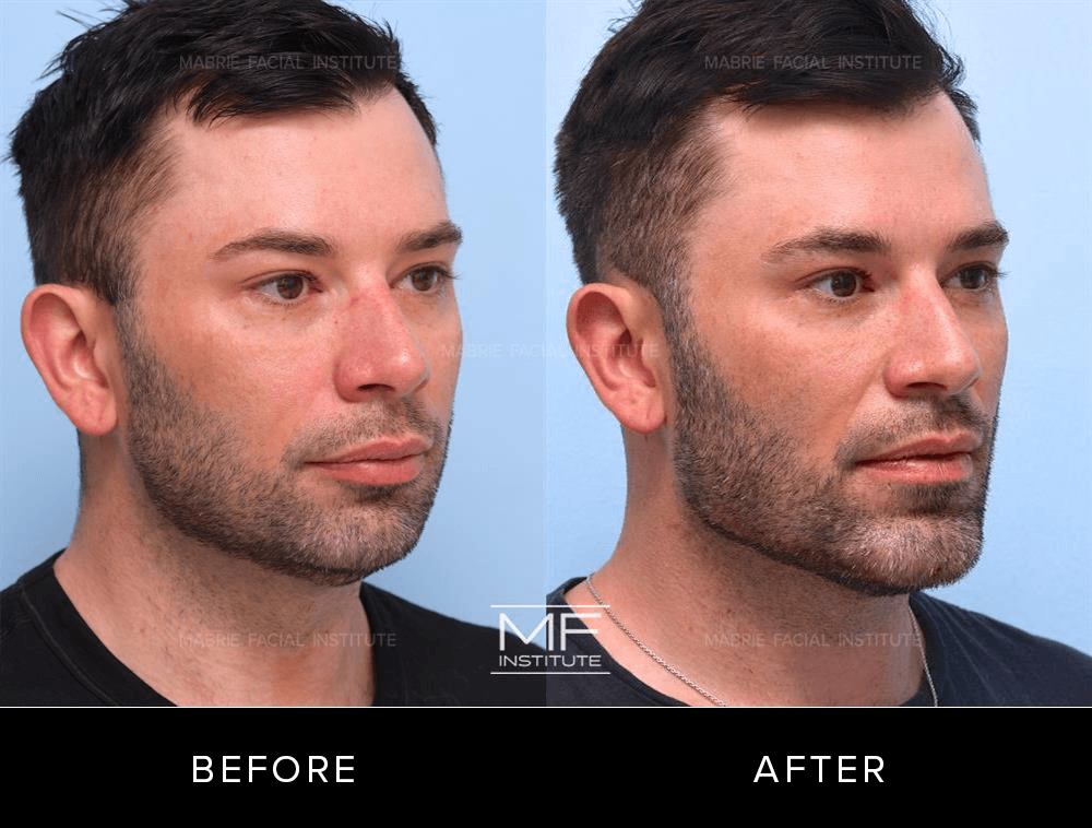 DCM Before After 726
