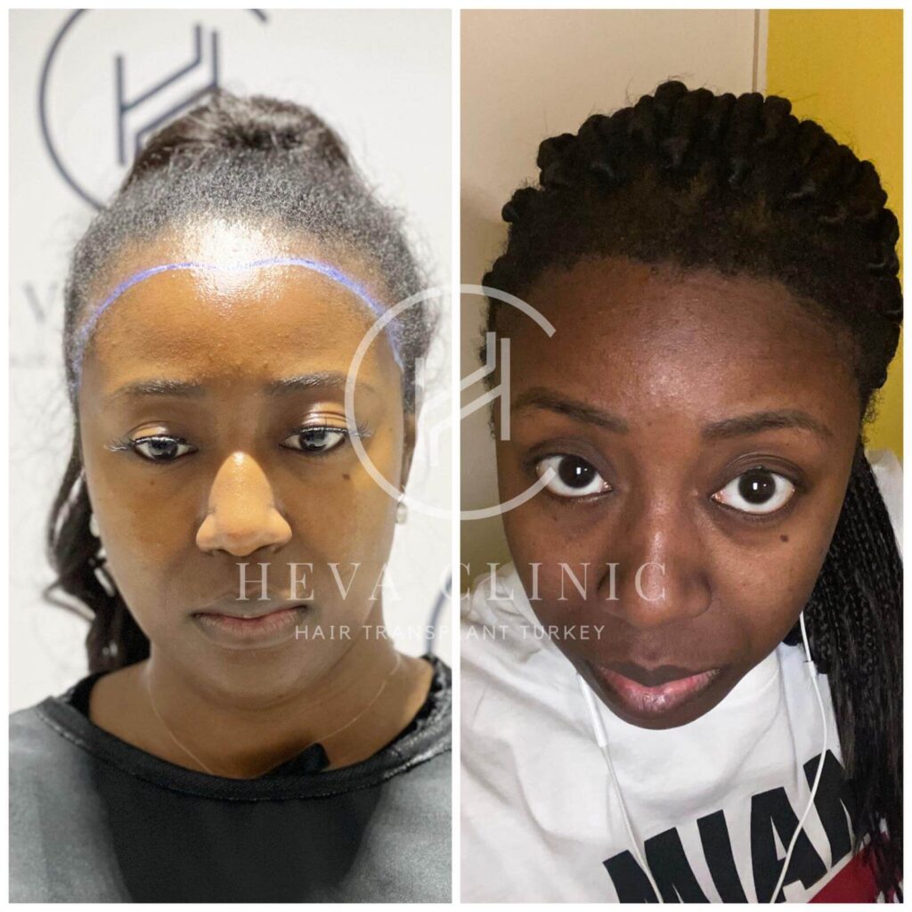 Female afro before after 2930 Grafts 1024x1024