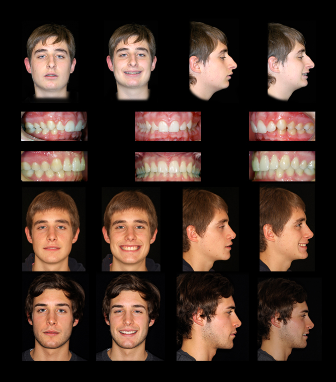 Raffaini before and after