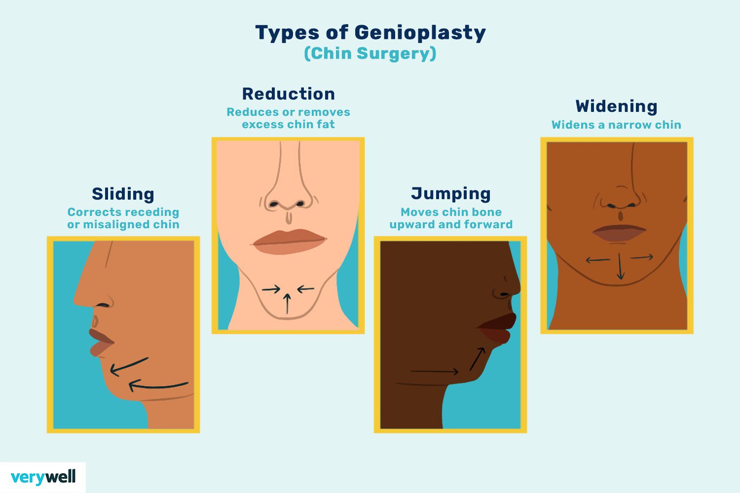 Genioplasty chin surgery overview 5089799 V2 DD e93c002f386b493c9185875e4867c980