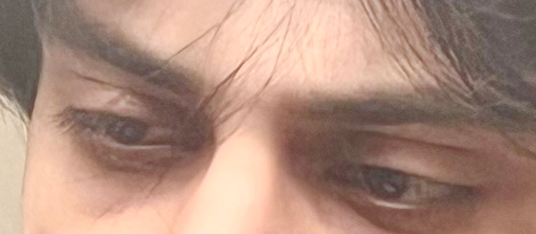 before eye.png