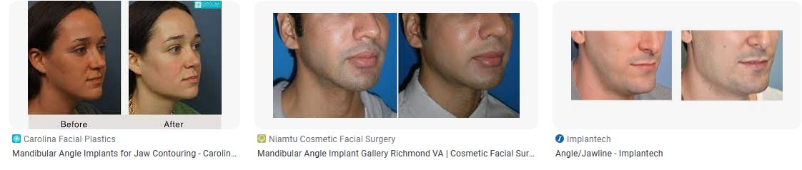 Jaw mandibular angle implants