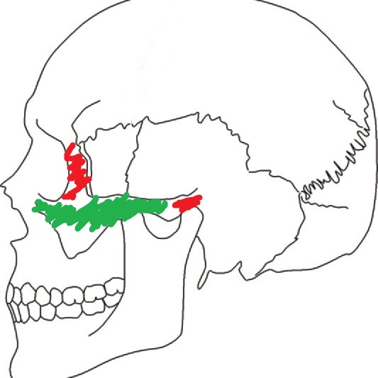 Drawing of the skull sagittal view shows the location of the coronal suture red Q640