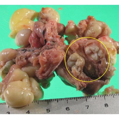 A Resected tumor 70 65 25cm and b cut surfaces The tumor was multilobular Q640