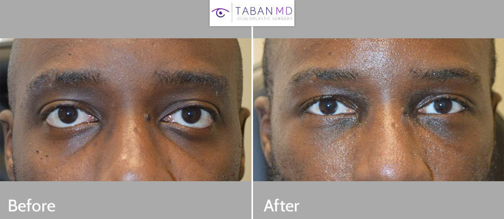 Infraorbital Rim Implant Before and After Front View Patient 2 Dr Taban