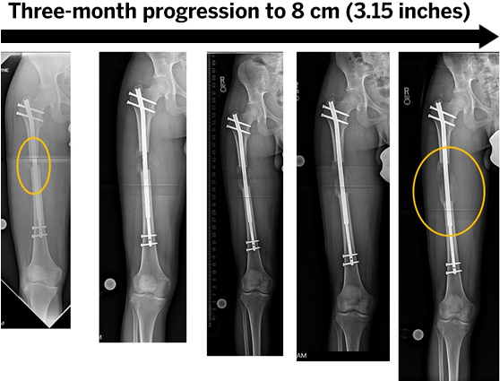 X ray osteotomy femur limb lengthening 8
