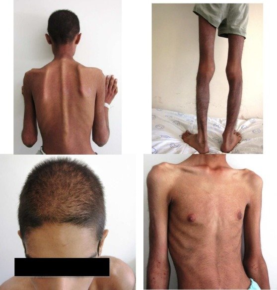 A male patient with anorexia nervosa