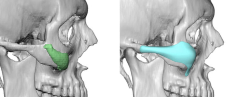 Custom vs Standard Male Cheek Implants side view Dr Barry Eppley Indianapolis 1 768x314