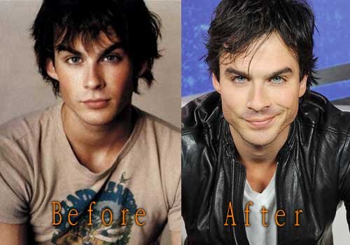 Ian Somerhalder Plastic Surgery