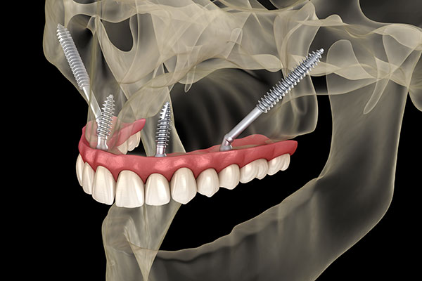 IMG Zygomatic Implants c1888