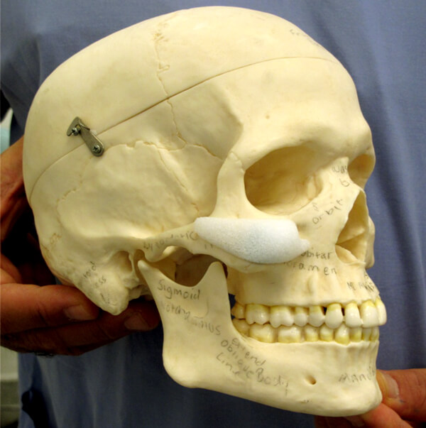 Pmfaam20 mid facial implants figures 4