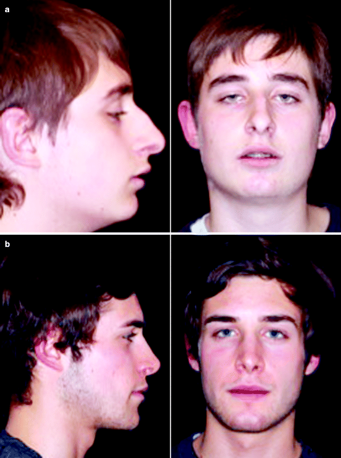 Raffaini before and after